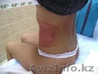  Криолиполиз -   революционная методика сжигания жира! Криолиполиз: все л - Изображение #3, Объявление #865089