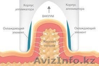  Криолиполиз -   революционная методика сжигания жира! Криолиполиз: все л - Изображение #6, Объявление #865089
