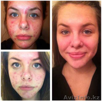 АРАБСКОЕ МЫЛО ОТ ПРЫЩЕЙ VOLCANIC ASH - Изображение #5, Объявление #1322833