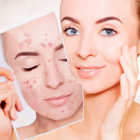 Анти акне пилинг - Изображение #1, Объявление #1678599