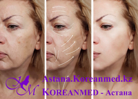 Инъекция «Золушка» или «Синдерелла» - Изображение #3, Объявление #1678588