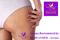 Лечение стрий (растяжек) Лазер «FOTONA» - Изображение #4, Объявление #1678642