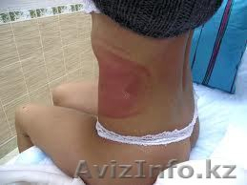  Криолиполиз -   революционная методика сжигания жира! Криолиполиз: все л - Изображение #3, Объявление #865089