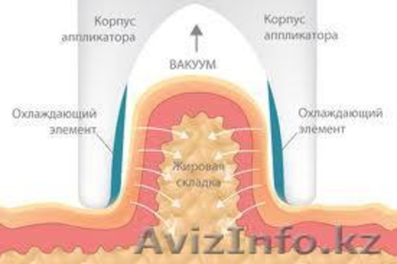  Криолиполиз -   революционная методика сжигания жира! Криолиполиз: все л - Изображение #6, Объявление #865089