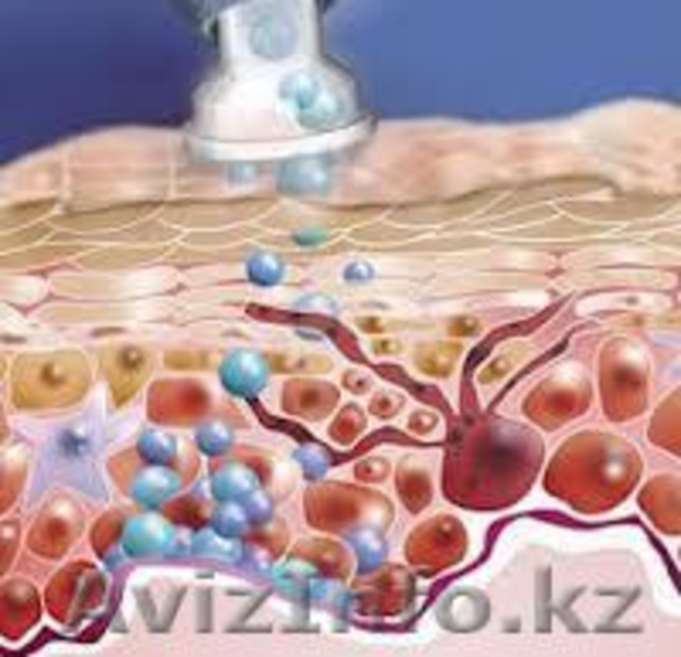 Кислородная безинъекционная мезотерапия - Изображение #2, Объявление #865097