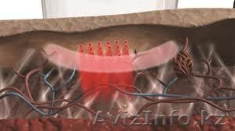  Омоложение лица – RF-лифтинг нового поколения  - Изображение #3, Объявление #865116