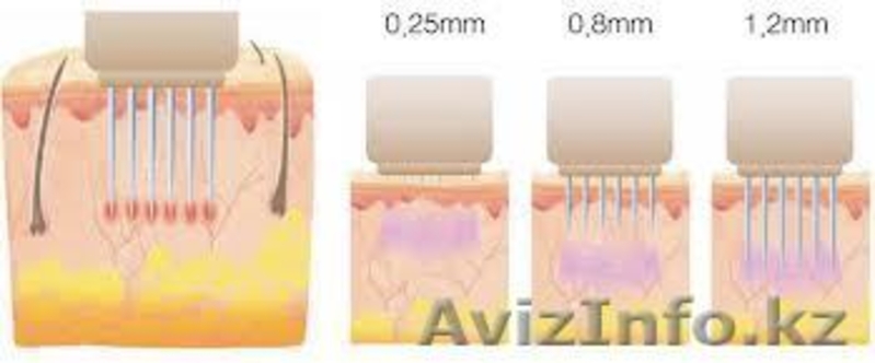  Омоложение лица – RF-лифтинг нового поколения  - Изображение #1, Объявление #865116