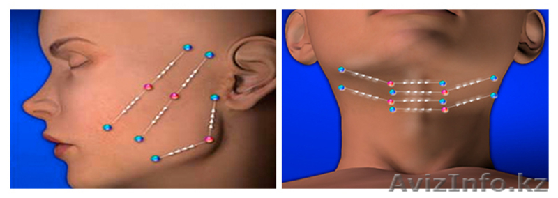 Нитевая подтяжка лица Силуэт Лифт Софт - Изображение #2, Объявление #1036719