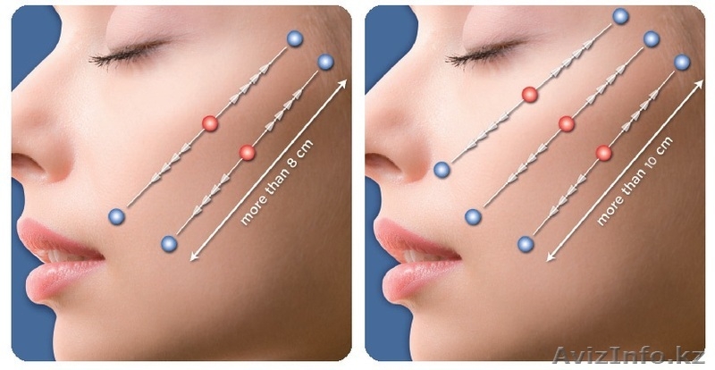 Нитевая подтяжка лица Силуэт Лифт Софт - Изображение #1, Объявление #1036719