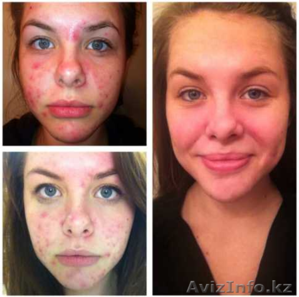 АРАБСКОЕ МЫЛО ОТ ПРЫЩЕЙ VOLCANIC ASH - Изображение #5, Объявление #1322833