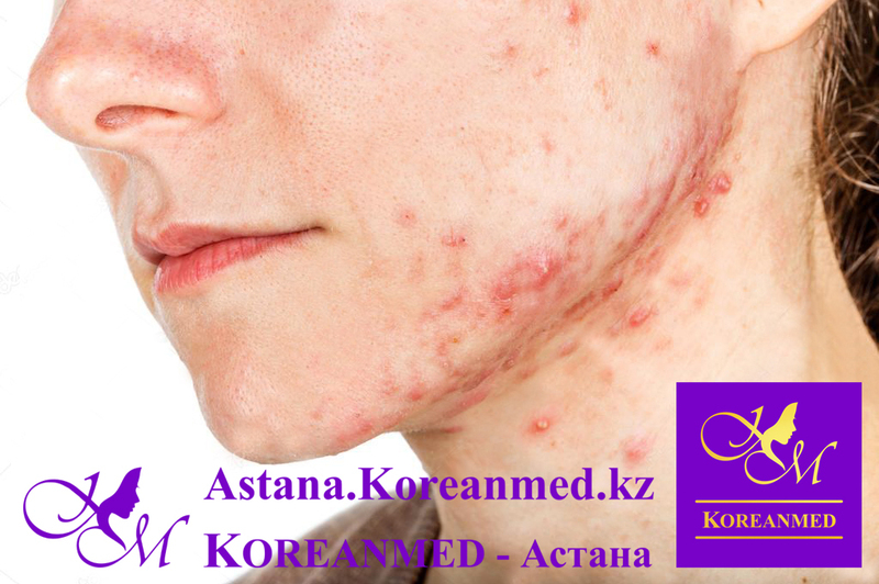 Лазерное лечение акне Лазер «FOTONA» - Изображение #3, Объявление #1678643