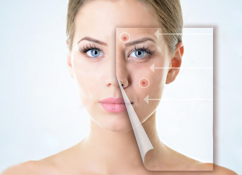 Лазерное лечение акне Лазер «FOTONA» - Изображение #1, Объявление #1678643