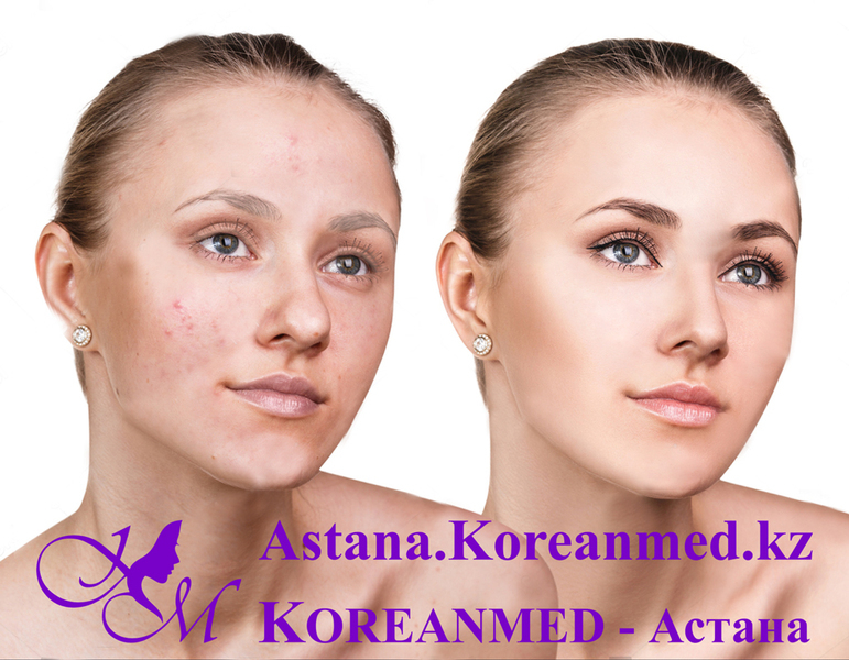 Пилинг миндальный - Изображение #2, Объявление #1678641