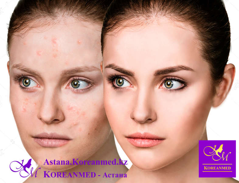 Анти акне пилинг - Изображение #2, Объявление #1678599