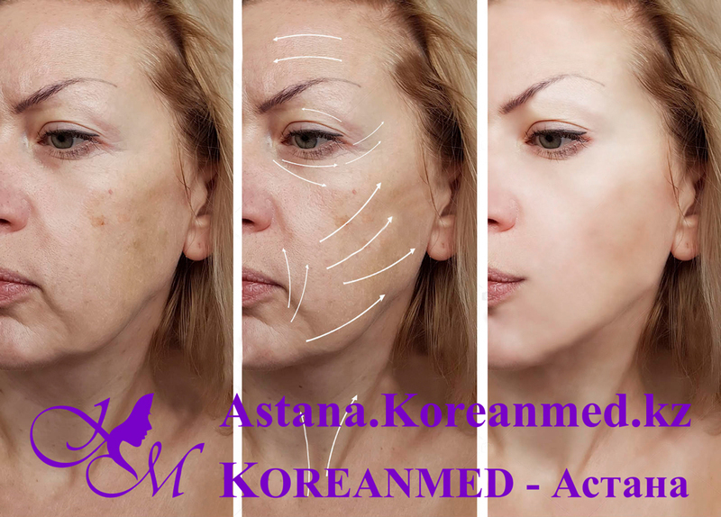 Инъекция «Золушка» или «Синдерелла» - Изображение #3, Объявление #1678588