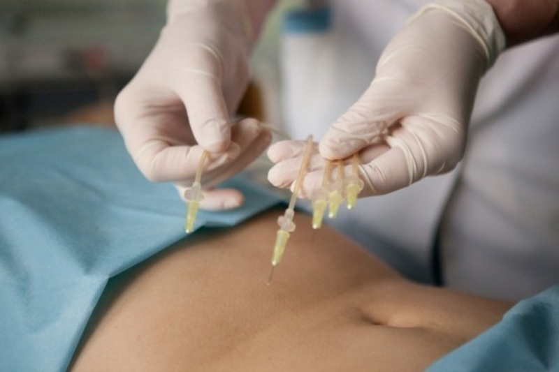 Озонотерапия внутривенно - Изображение #4, Объявление #1678585