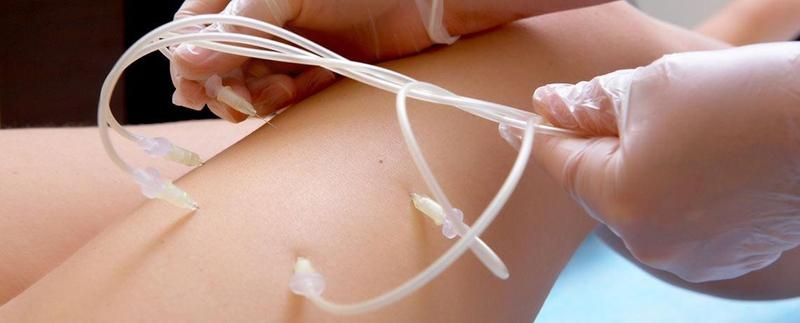 Озонотерапия внутривенно - Изображение #5, Объявление #1678585