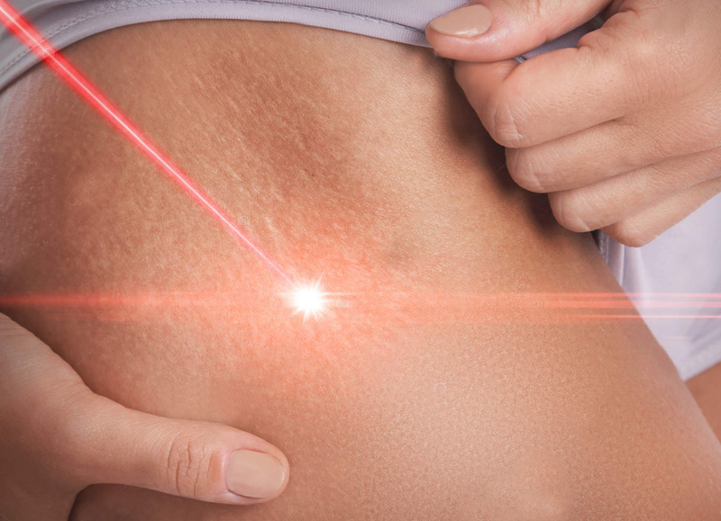 Лечение стрий (растяжек) Лазер «FOTONA» - Изображение #1, Объявление #1678642