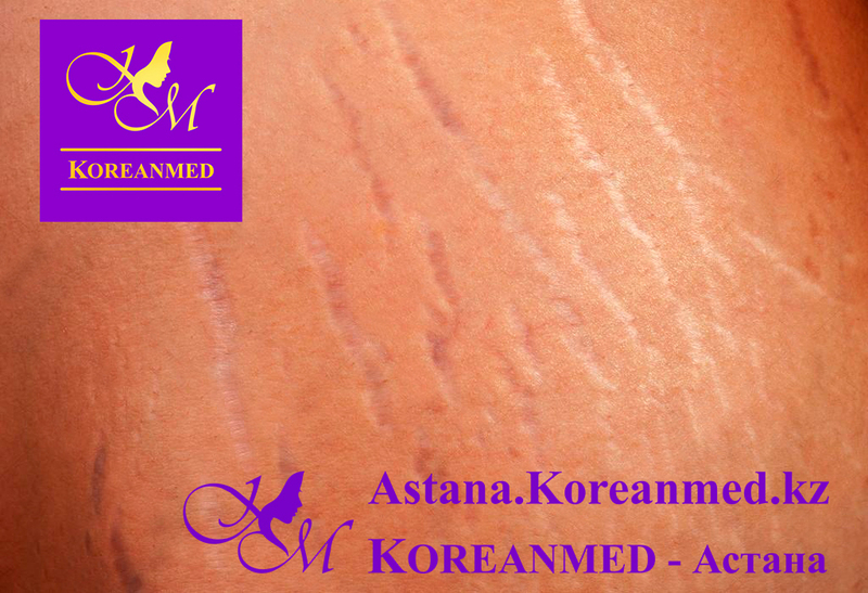 Лечение стрий (растяжек) Лазер «FOTONA» - Изображение #2, Объявление #1678642