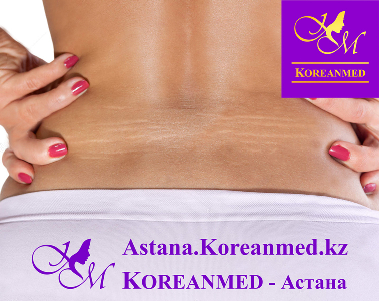 Лечение стрий (растяжек) Лазер «FOTONA» - Изображение #3, Объявление #1678642